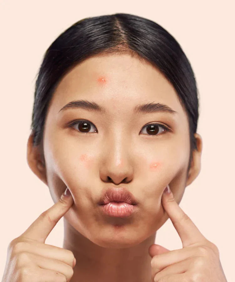 Acné & Éruptions Cutanées